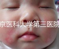 北京醫(yī)科大學(xué)第三醫(yī)院nt檢查費(fèi)用盤點(diǎn)需要多長(zhǎng)時(shí)間，是否預(yù)約