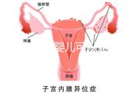三代試管嬰兒可以避免重癥聯(lián)合免疫缺陷病遺傳嗎