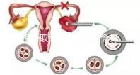 揭秘取卵后醫(yī)生會不會打電話問選幾代？這些問題會涉及到
