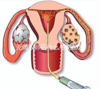無(wú)痛取卵后什么感覺(jué)都沒(méi)有異常是謠言！只會(huì)出現(xiàn)一部分...