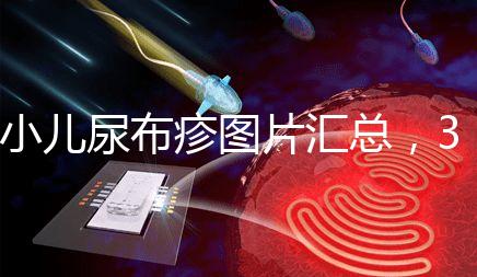 小兒尿布疹圖片匯總,3種類(lèi)型癥狀大不一樣