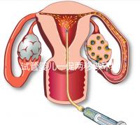 試管嬰兒一促兩移做環(huán)扎好看嗎？小心這些影響