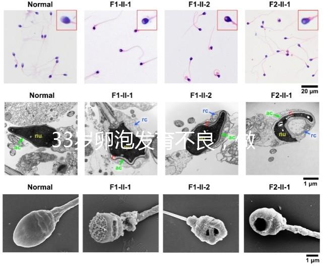 33歲卵泡發(fā)育不良，做試管黃體期促排方案失敗怎么辦？